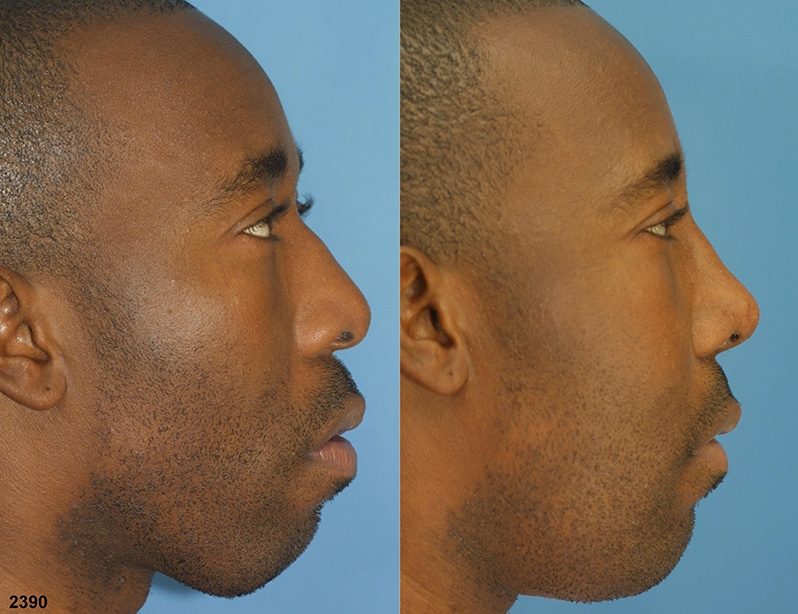NYC Facial Plastic Surgery Rhinoplasty