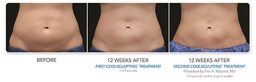 New York Fat Reduction Procedure