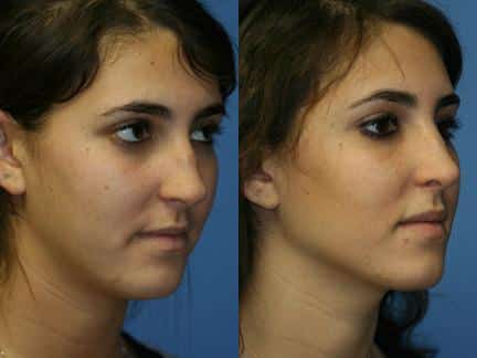New York Rhinoplasty Correction