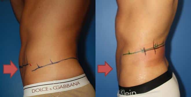 NYV Body Contouring Procedure