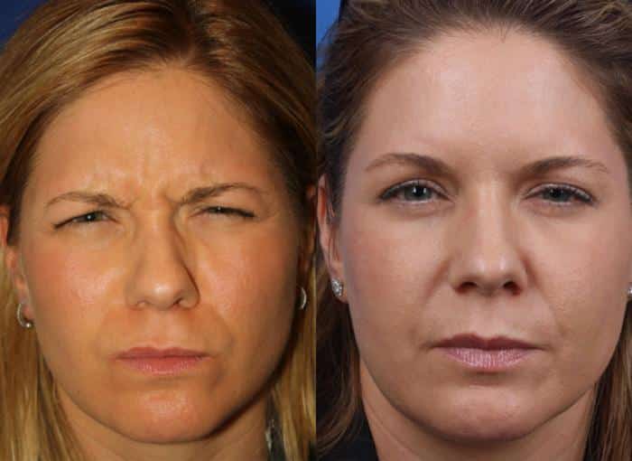 Botox Injectable Results NYC