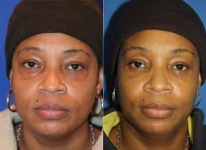 New York Eyelid before and after Surgery Results