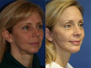 NYC Forehead Lift Procedure