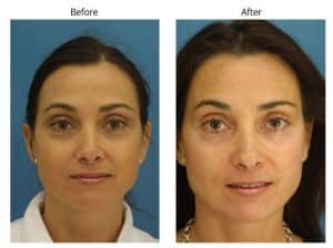 NYC Blepharoplasty before and after Procedure Results