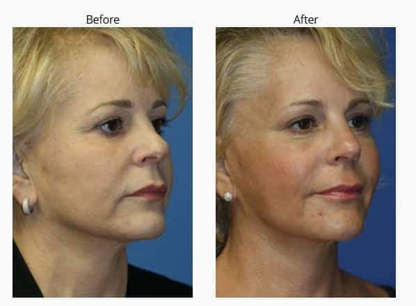 New York Anti-Aging Facial Surgery