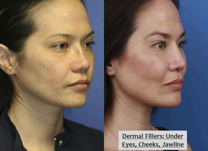 Image showing a woman who received dermal fillers under her eyes, cheeks and jawline. The dermal fillers made a huge difference in her looks by removing saggy skin and wrinkles, New York, NY 