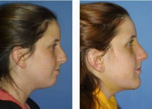 New York chin Plastic Surgery