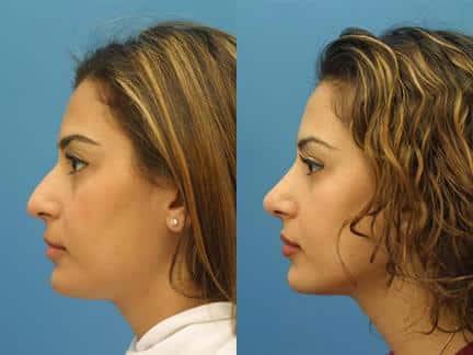 Hispanic Rhinoplasty New York City, New York | Dr. Philip Miller