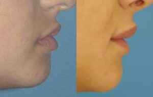 New York Lip Reduction Procedure