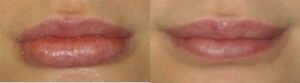 NYC Lip Reduction Procedure